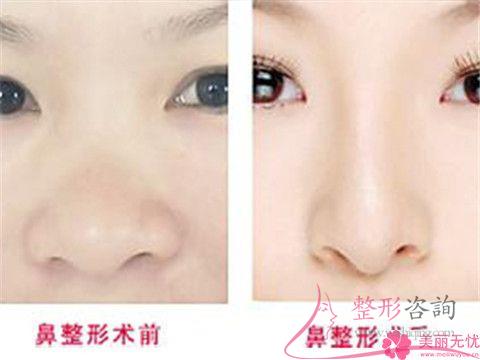 過大的<a href=http://www.bolangguoji.com/listinfo-754-0.html target=_blank class=infotextkey>鼻翼</a>是需如何矯正