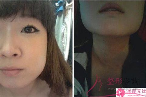 顴骨削骨術(shù)需要注意哪些事項(xiàng)