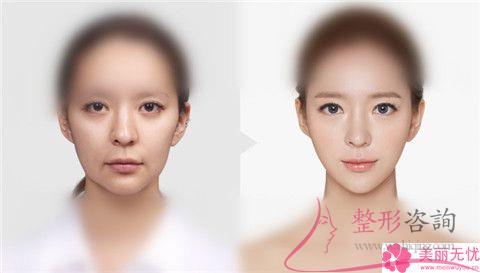做縮小<a href=http://www.bolangguoji.com/listinfo-754-0.html target=_blank class=infotextkey>鼻翼</a>術(shù)是什么價(jià)格