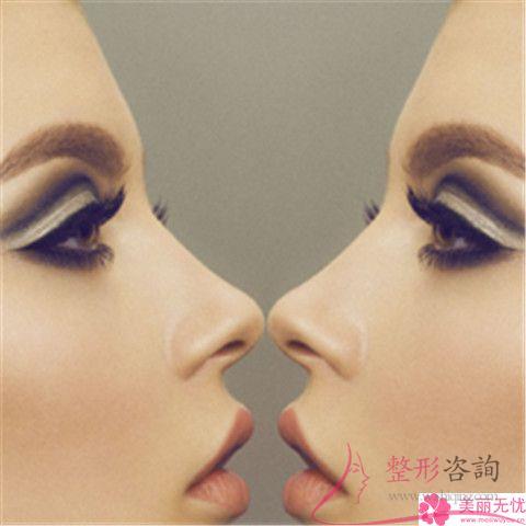 做縮小<a href=http://www.bolangguoji.com/listinfo-754-0.html target=_blank class=infotextkey>鼻翼</a>的價格如何收費(fèi)