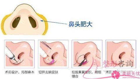 做<a href=http://www.bolangguoji.com/listinfo-754-0.html target=_blank class=infotextkey>鼻翼</a>整形術價格介紹