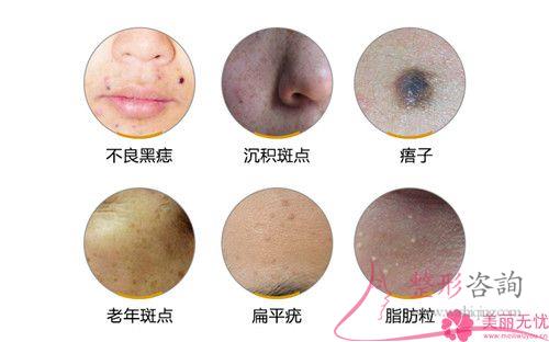 醫美<a href=http://www.bolangguoji.com/listinfo-795-0.html target=_blank class=infotextkey>祛斑</a>期間如果臉上特別紅正常嗎