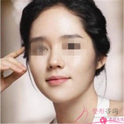 <a href=http://www.bolangguoji.com/listinfo-737-0.html target=_blank class=infotextkey>隆鼻</a>手術(shù)失敗具體是由于什么原因造成