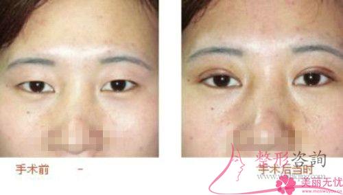 上瞼提肌縮短術的手術費用一般是8237元嗎