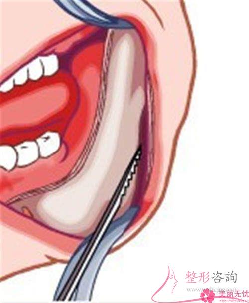 下頜骨磨骨并發(fā)癥高嗎