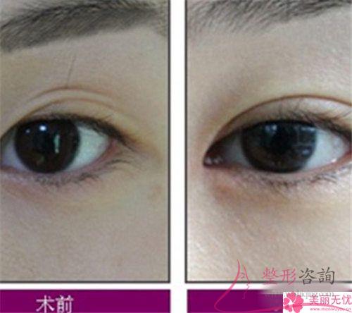 割<a href=http://www.bolangguoji.com/listinfo-724-0.html target=_blank class=infotextkey>雙眼皮</a>手術(shù)不理想情況有些什么
