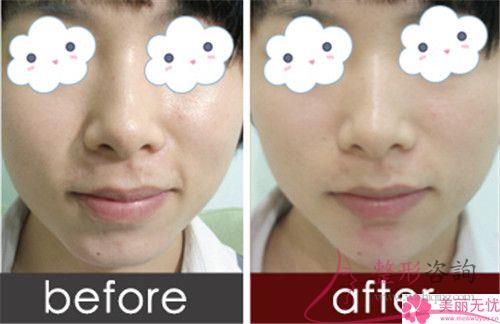 注入水動力<a href=http://www.bolangguoji.com/listinfo-682-0.html target=_blank class=infotextkey>溶脂</a><a href=http://www.bolangguoji.com/listinfo-631-0.html target=_blank class=infotextkey>瘦臉</a>對身子會有影響嗎