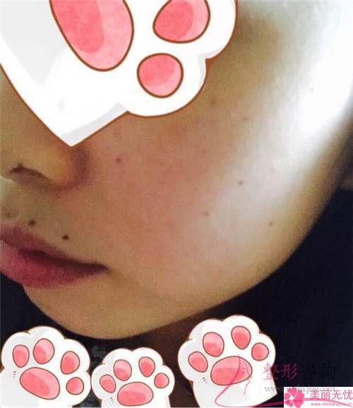 激光去咖啡斑手術(shù)只滿足身體健康便能嗎？