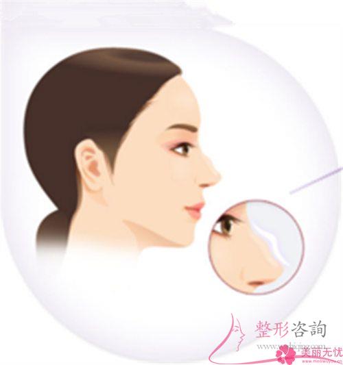 膨體聚四氟乙烯<a href=http://www.bolangguoji.com/listinfo-737-0.html target=_blank class=infotextkey>隆鼻</a>術(shù)靠譜嗎？是否有造成感染？