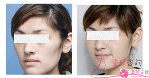 面頰<a href=http://www.bolangguoji.com/listinfo-682-0.html target=_blank class=infotextkey>溶脂</a>見效真的好嗎