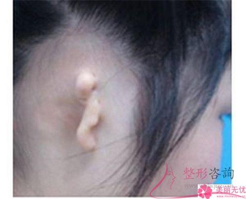 <a href=http://www.bolangguoji.com/listinfo-698-0.html target=_blank class=infotextkey>招風耳矯正</a>手術可以使用免拆除的縫線嗎