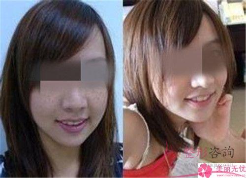 點(diǎn)陣激光祛色斑要經(jīng)歷多久治療周期