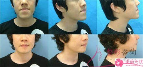 <a href=http://www.bolangguoji.com/listinfo-629-0.html target=_blank class=infotextkey>下頜角</a>截骨手術的費用在12154-21849元之間嗎