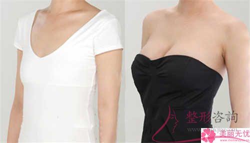 假體<a href=http://www.bolangguoji.com/listinfo-618-0.html target=_blank class=infotextkey>隆胸</a>費用大致是多少？