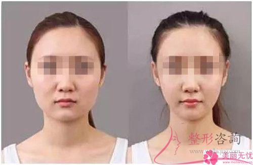 做<a href=http://www.bolangguoji.com/listinfo-631-0.html target=_blank class=infotextkey>瘦臉</a>磨骨有什么并發癥