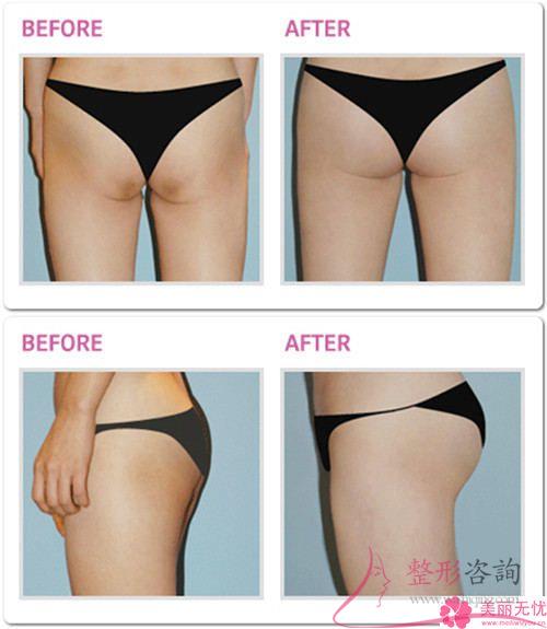 哪些女人可以做自體組織<a href=http://www.bolangguoji.com/listinfo-677-0.html target=_blank class=infotextkey>豐臀</a>術