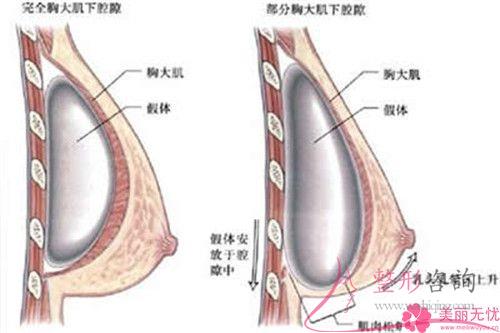 通常多久手術自體脂肪豐胸好