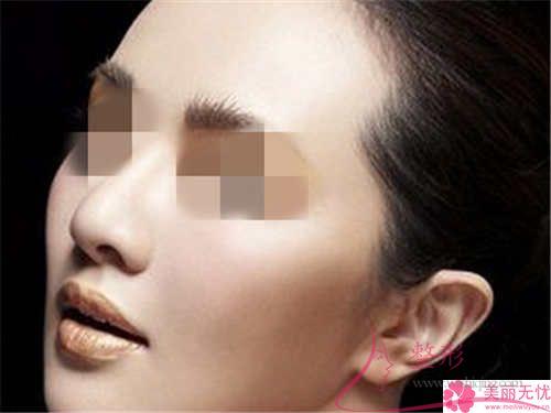 鼻中隔軟骨<a href=http://www.bolangguoji.com/listinfo-737-0.html target=_blank class=infotextkey>隆鼻</a>的費用大概得花多少錢