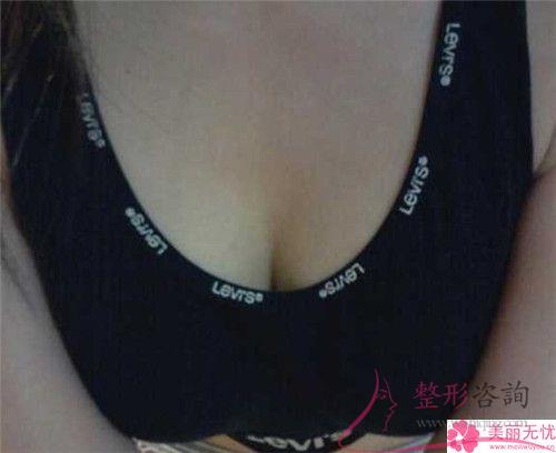 女性實施<a href=http://www.bolangguoji.com/listinfo-625-0.html target=_blank class=infotextkey>乳暈縮小</a>手術的成功率是100%嗎
