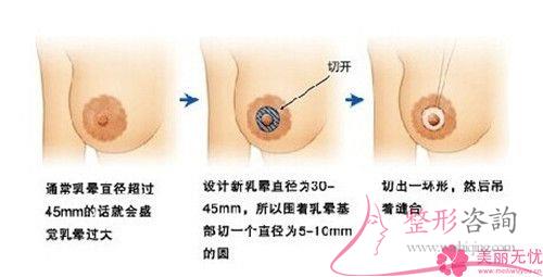 女性實施<a href=http://www.bolangguoji.com/listinfo-625-0.html target=_blank class=infotextkey>乳暈縮小</a>手術的成功率是100%嗎