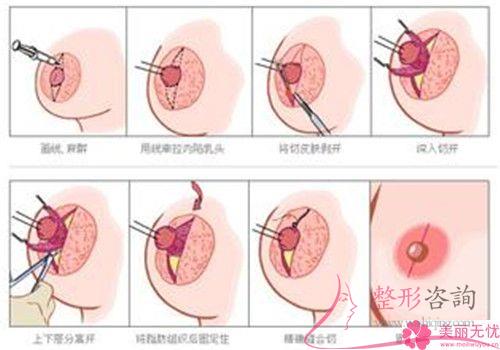 女性實施<a href=http://www.bolangguoji.com/listinfo-625-0.html target=_blank class=infotextkey>乳暈縮小</a>手術的成功率是100%嗎