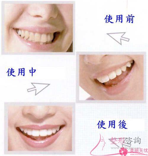 牙齒修復顆牙齒要準備多少？