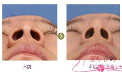 縮小<a href=http://www.bolangguoji.com/listinfo-754-0.html target=_blank class=infotextkey>鼻翼</a>怎么避免瘢痕增生