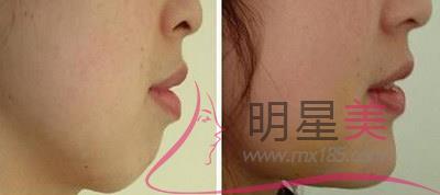 <a href=http://www.bolangguoji.com/listinfo-635-0.html target=_blank class=infotextkey>去頰脂墊</a>術(shù)后護(hù)理