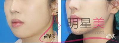 <a href=http://www.bolangguoji.com/listinfo-635-0.html target=_blank class=infotextkey>去頰脂墊</a>術(shù)后注意事項(xiàng)
