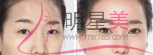 怎么清除額頭上的皺紋