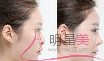 打<a href=http://www.bolangguoji.com/listinfo-731-0.html target=_blank class=infotextkey>玻尿酸</a>什么用
