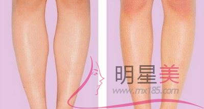 大腿抽脂沒有穿塑身褲