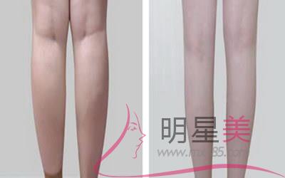 大腿內(nèi)側(cè)長出疤痕