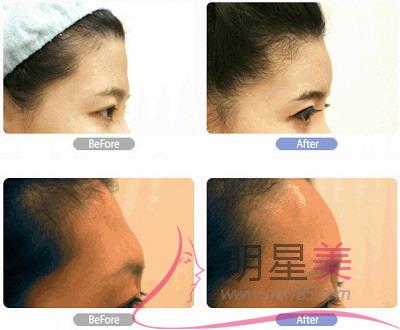 額頭<a href=http://www.bolangguoji.com/listinfo-754-0.html target=_blank class=infotextkey>鼻翼</a>兩側下巴長痘痘什么原因啊