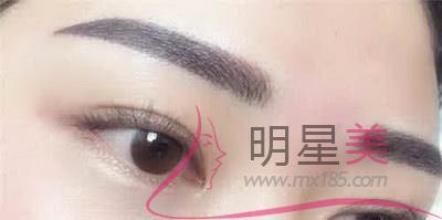 提眉手術記錄