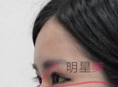 拔牙后太陽穴