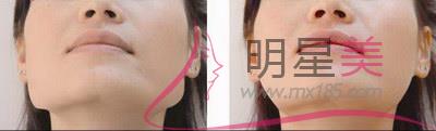 下頜緣<a href=http://www.bolangguoji.com/listinfo-685-0.html target=_blank class=infotextkey>吸脂</a>頭套戴多久效果最佳