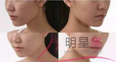 廣州下頜緣<a href=http://www.bolangguoji.com/listinfo-685-0.html target=_blank class=infotextkey>吸脂</a>