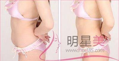 哪家超聲<a href=http://www.bolangguoji.com/listinfo-682-0.html target=_blank class=infotextkey>溶脂</a>好