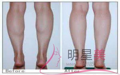 有什么瘦腿的好辦法