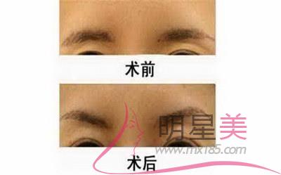 撫州<a href=http://www.bolangguoji.com/listinfo-652-0.html target=_blank class=infotextkey>眉毛種植</a>毛種植