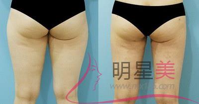 腿部<a href=http://www.bolangguoji.com/listinfo-685-0.html target=_blank class=infotextkey>吸脂</a>后會(huì)變漂亮嗎