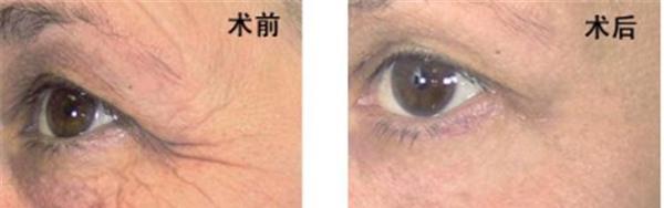 做激光除魚尾紋不適應人群有哪些