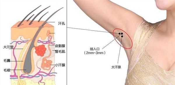 做冷凍法<a href=http://www.bolangguoji.com/listinfo-766-0.html target=_blank class=infotextkey>去腋臭</a>風(fēng)險有哪些
