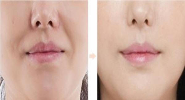 做懸吊<a href=http://www.bolangguoji.com/listinfo-614-0.html target=_blank class=infotextkey>除皺</a><a href=http://www.bolangguoji.com/listinfo-792-0.html target=_blank class=infotextkey>去法令紋</a>手術時間是多久？