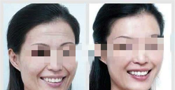 做自體脂肪<a href=http://www.bolangguoji.com/listinfo-765-0.html target=_blank class=infotextkey>去抬頭紋</a>費用多少錢
