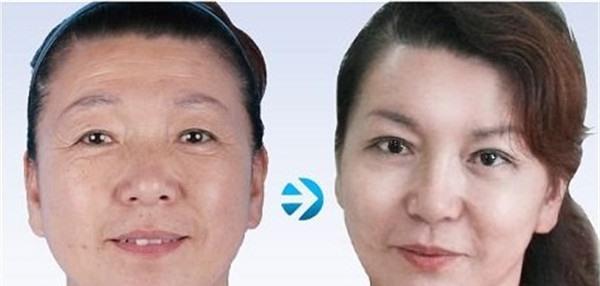做<a href=http://www.bolangguoji.com/listinfo-731-0.html target=_blank class=infotextkey>玻尿酸</a><a href=http://www.bolangguoji.com/listinfo-765-0.html target=_blank class=infotextkey>去抬頭紋</a>價格