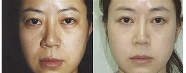 做激光祛曬斑的流程是什么？恢復時間要多久？