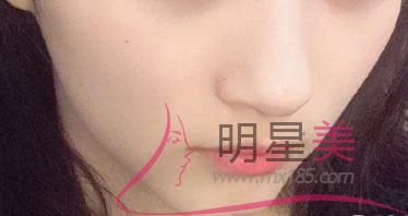抽脂<a href=http://www.bolangguoji.com/listinfo-630-0.html target=_blank class=infotextkey>豐太陽穴</a>的副作用
