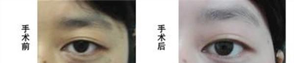 冷凍去除太田痣手術的方法是什么？